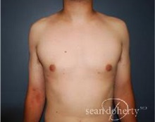 Male Breast Reduction After Photo by Sean Doherty, MD; Brookline, MA - Case 33416