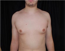 Male Breast Reduction Before Photo by Sean Doherty, MD; Brookline, MA - Case 33416