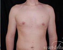 Male Breast Reduction After Photo by Sean Doherty, MD; Brookline, MA - Case 33418
