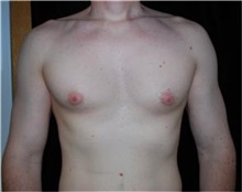 Male Breast Reduction Before Photo by Sean Doherty, MD; Brookline, MA - Case 33418
