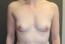 Breast Augmentation Before Photo by Sean Doherty, MD; Brookline, MA - Case 42754