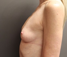 Breast Augmentation Before Photo by Sean Doherty, MD; Brookline, MA - Case 42759