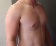 Male Breast Reduction After Photo by Sean Doherty, MD; Brookline, MA - Case 42760