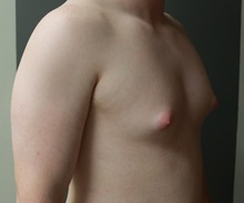 Male Breast Reduction Before Photo by Sean Doherty, MD; Brookline, MA - Case 42760