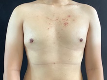 Male Breast Reduction After Photo by Sean Doherty, MD; Brookline, MA - Case 42761