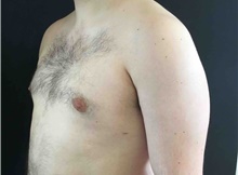 Male Breast Reduction After Photo by Sean Doherty, MD; Brookline, MA - Case 42762