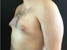 Male Breast Reduction Before Photo by Sean Doherty, MD; Brookline, MA - Case 42762