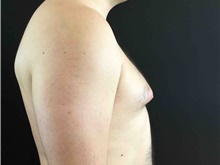 Male Breast Reduction Before Photo by Sean Doherty, MD; Brookline, MA - Case 42762