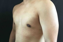Male Breast Reduction After Photo by Sean Doherty, MD; Brookline, MA - Case 42764
