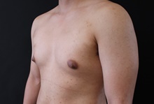 Male Breast Reduction Before Photo by Sean Doherty, MD; Brookline, MA - Case 42764