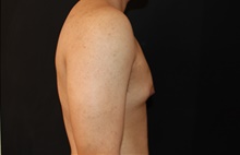 Male Breast Reduction Before Photo by Sean Doherty, MD; Brookline, MA - Case 42764