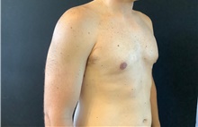 Male Breast Reduction After Photo by Sean Doherty, MD; Brookline, MA - Case 42765