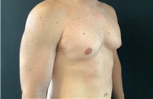 Male Breast Reduction Before Photo by Sean Doherty, MD; Brookline, MA - Case 42765
