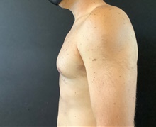 Male Breast Reduction After Photo by Sean Doherty, MD; Brookline, MA - Case 42765