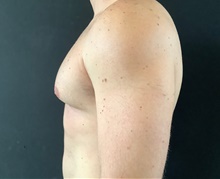 Male Breast Reduction Before Photo by Sean Doherty, MD; Brookline, MA - Case 42765