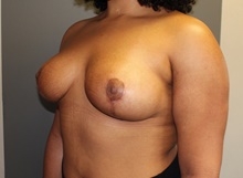 Breast Lift After Photo by Sean Doherty, MD; Brookline, MA - Case 42766