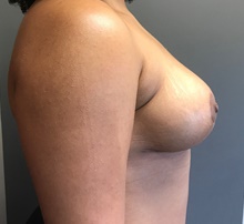 Breast Lift After Photo by Sean Doherty, MD; Brookline, MA - Case 42766