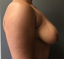 Breast Lift Before Photo by Sean Doherty, MD; Brookline, MA - Case 42766