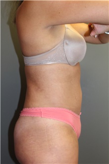 Liposuction After Photo by Sean Doherty, MD; Brookline, MA - Case 42769