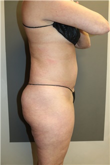 Liposuction Before Photo by Sean Doherty, MD; Brookline, MA - Case 42769