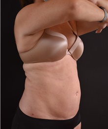 Liposuction After Photo by Sean Doherty, MD; Brookline, MA - Case 42770