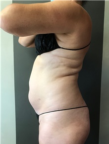Liposuction Before Photo by Sean Doherty, MD; Brookline, MA - Case 42770