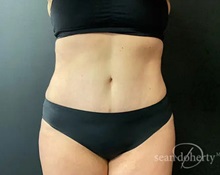 Tummy Tuck After Photo by Sean Doherty, MD; Chestnut Hill, MA - Case 50011