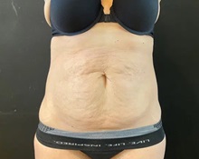 Tummy Tuck Before Photo by Sean Doherty, MD; Chestnut Hill, MA - Case 50011