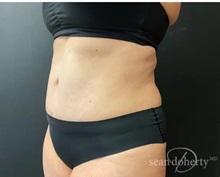 Tummy Tuck After Photo by Sean Doherty, MD; Chestnut Hill, MA - Case 50011