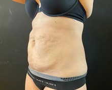 Tummy Tuck Before Photo by Sean Doherty, MD; Chestnut Hill, MA - Case 50011