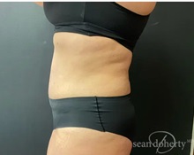 Tummy Tuck After Photo by Sean Doherty, MD; Chestnut Hill, MA - Case 50011