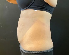 Tummy Tuck Before Photo by Sean Doherty, MD; Chestnut Hill, MA - Case 50011