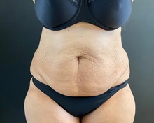 Tummy Tuck Before Photo by Sean Doherty, MD; Chestnut Hill, MA - Case 50013