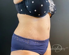 Tummy Tuck After Photo by Sean Doherty, MD; Chestnut Hill, MA - Case 50013