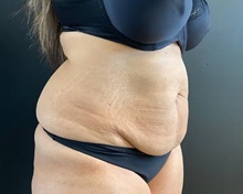 Tummy Tuck Before Photo by Sean Doherty, MD; Chestnut Hill, MA - Case 50013