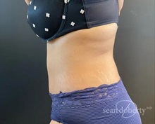 Tummy Tuck After Photo by Sean Doherty, MD; Chestnut Hill, MA - Case 50013