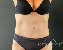 Tummy Tuck After Photo by Sean Doherty, MD; Chestnut Hill, MA - Case 50034