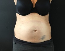Tummy Tuck Before Photo by Sean Doherty, MD; Chestnut Hill, MA - Case 50034