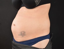 Tummy Tuck Before Photo by Sean Doherty, MD; Chestnut Hill, MA - Case 50034