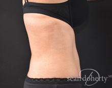 Tummy Tuck After Photo by Sean Doherty, MD; Chestnut Hill, MA - Case 50034
