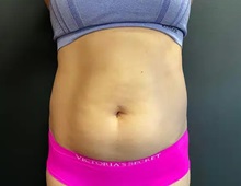 Liposuction Before Photo by Sean Doherty, MD; Chestnut Hill, MA - Case 50046