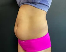 Liposuction Before Photo by Sean Doherty, MD; Chestnut Hill, MA - Case 50046