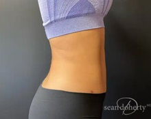Liposuction After Photo by Sean Doherty, MD; Chestnut Hill, MA - Case 50046