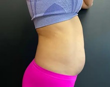 Liposuction Before Photo by Sean Doherty, MD; Chestnut Hill, MA - Case 50046
