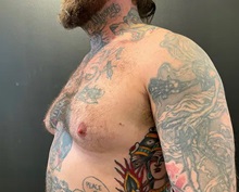 Male Breast Reduction Before Photo by Sean Doherty, MD; Chestnut Hill, MA - Case 50042