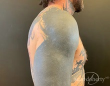 Male Breast Reduction After Photo by Sean Doherty, MD; Chestnut Hill, MA - Case 50042