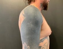 Male Breast Reduction Before Photo by Sean Doherty, MD; Chestnut Hill, MA - Case 50042