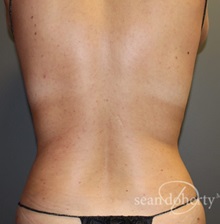 Liposuction After Photo by Sean Doherty, MD; Chestnut Hill, MA - Case 50048 Liposuction After Photo by Sean Doherty, MD; Chestnut Hill, MA - Case 50048