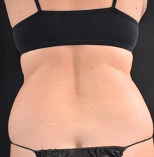 Liposuction Before Photo by Sean Doherty, MD; Chestnut Hill, MA - Case 50048 Liposuction Before Photo by Sean Doherty, MD; Chestnut Hill, MA - Case 50048
