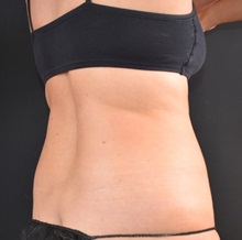 Liposuction Before Photo by Sean Doherty, MD; Chestnut Hill, MA - Case 50048